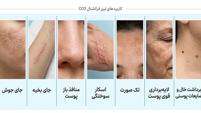 کاربردهای لیزر CO2 فرکشنال