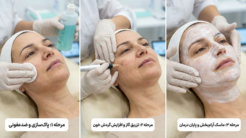 مراحل کربوکسی تراپی صورت